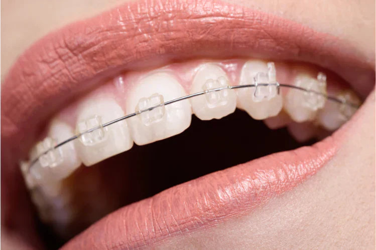 A girl wearing ceramic braces