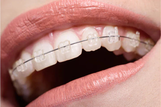 A girl wearing ceramic braces