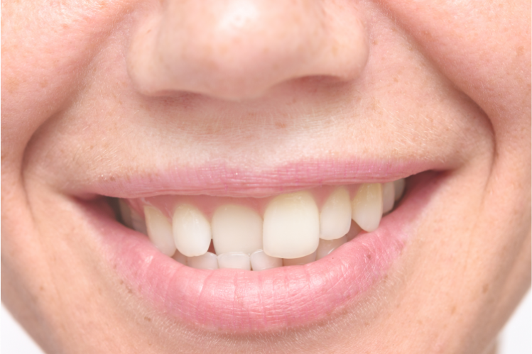 Close-up of a person smiling to show crooked teeth