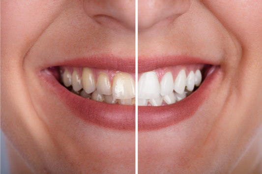 Woman's teeth before and after whitening