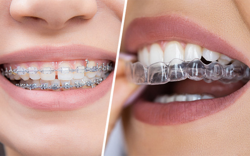 Ceramic/clear braces or metal braces – what are the differences?