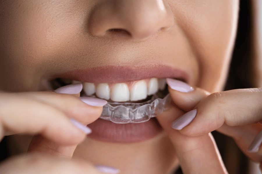 Achieve a Straighter Smile with Clear Aligners – Aligner32