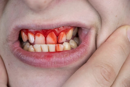 Severe bleeding of the gums