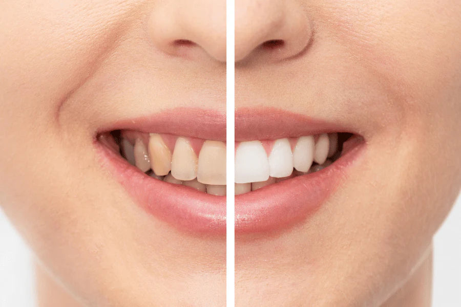 teeth whitening