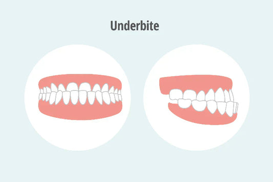 An illustration of an underbite (class 3 bite)