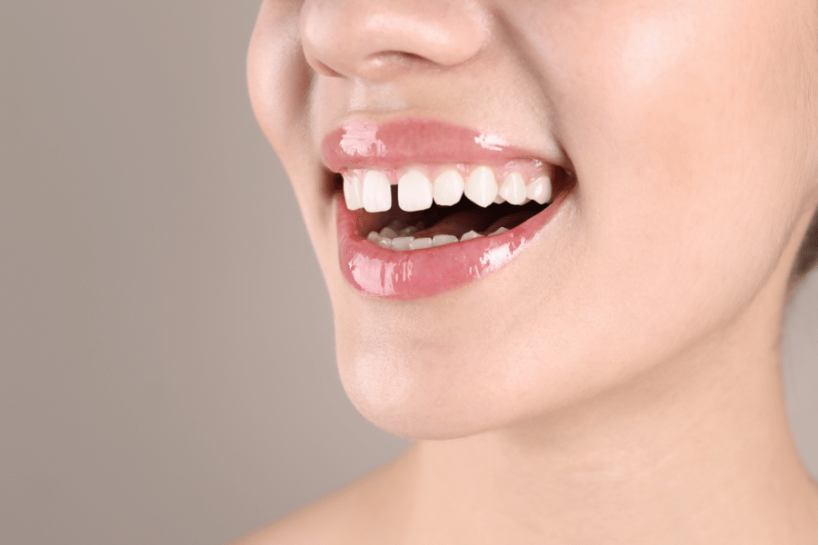 Fix teeth gap with clear aligners