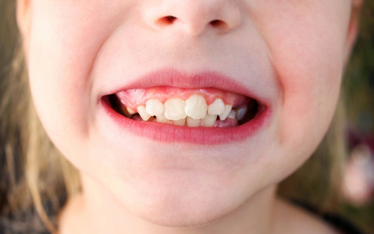 A close-up of a child with misaligned teeth