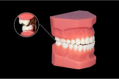 Understanding Class 1 Bite, Probable Issues, and How Aligner32 Can Help You Achieve it