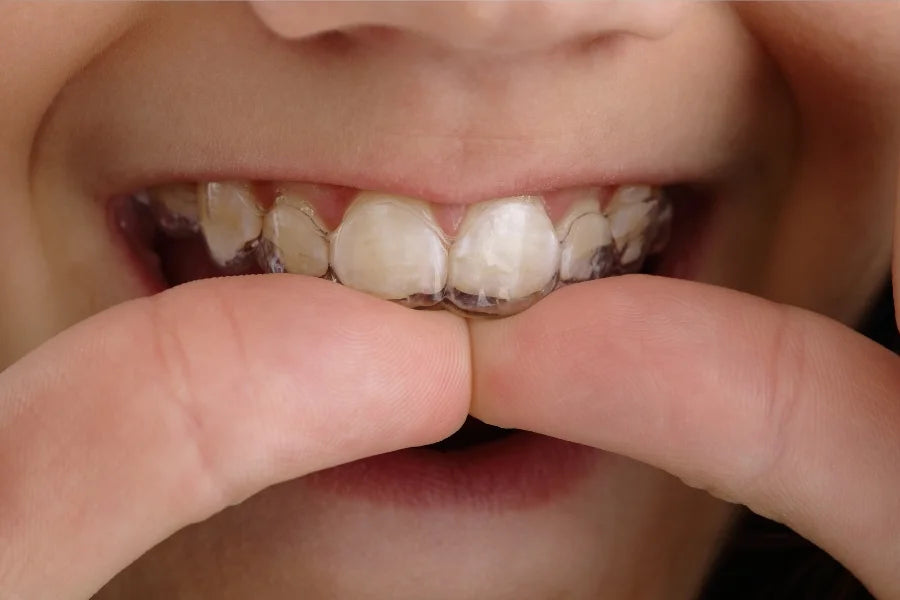 A girl applying clear retainers.