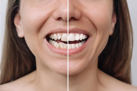 A picture showing the before and after transformation of a woman with uneven teeth