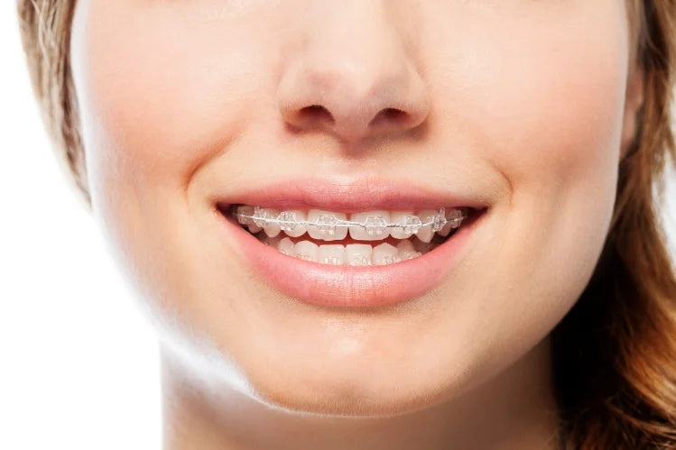 A woman smiling while wearing ceramic braces