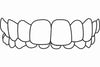 Understanding Overbite: Causes, Effects, and Treatment Options