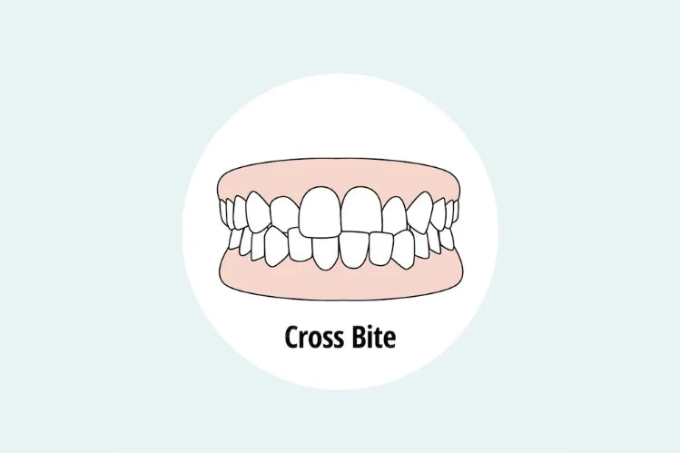 An image of a crossbite