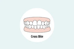 Crossbite Explained: Causes, Types, and How to Fix It