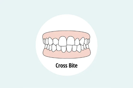 An image of a crossbite