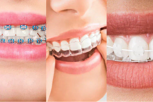 An image of types of braces, Metal, clear, and ceramic