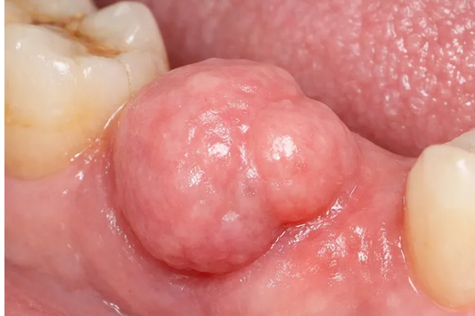  A close of dental odontoma 