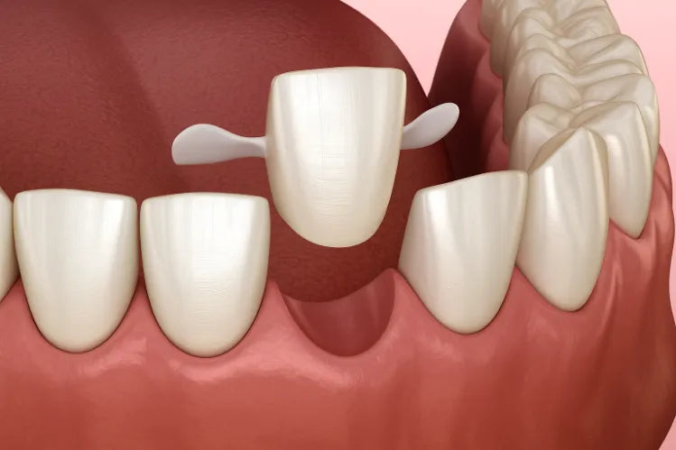 An illustration of a Maryland bridge being placed on teeth.