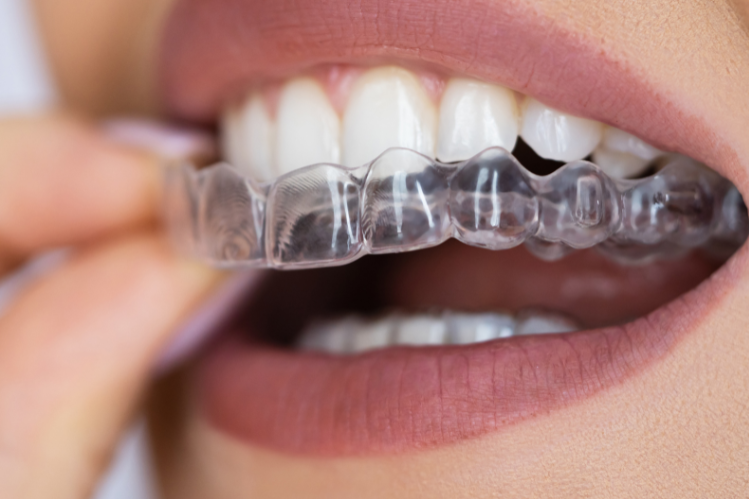 A close-up of a girl applying clear aligners