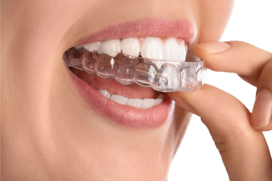 A girl applying aligners in her upper tooth arch