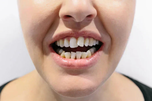 A woman showing an open mouth with crooked teeth