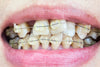 Transform Your Smile: Clear Aligners for Crooked Bottom Teeth Made Easy with Aligner32