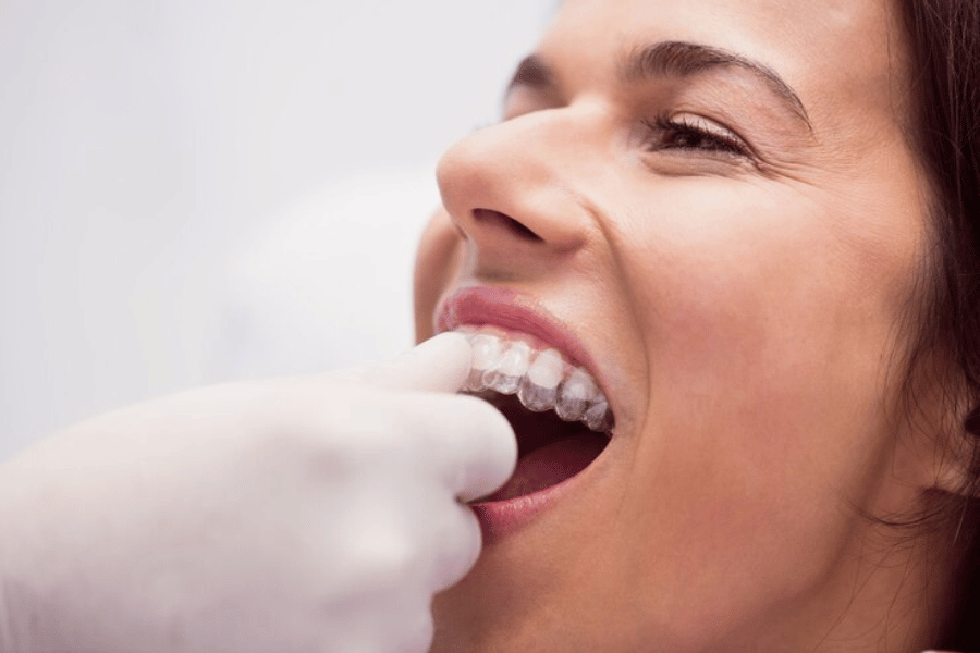 clear aligners for teeth straightening.