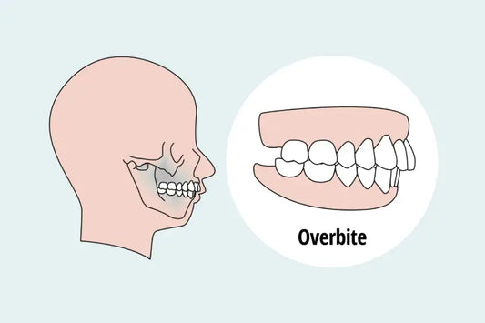 Illustration of class 2 bite in comparison to a normal bite and an underbite