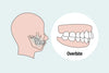 Class 2 Bite: The Ultimate Guide to Treating and Correcting Overbite Issues