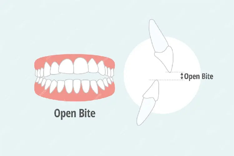 Illustration of what open bite looks like