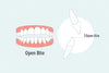 Understanding Open Bite: Causes, Risks, and How Clear Aligners Can Help