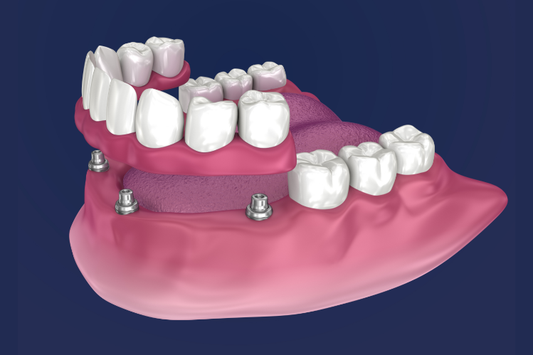 An illustration of implant-supported dentures