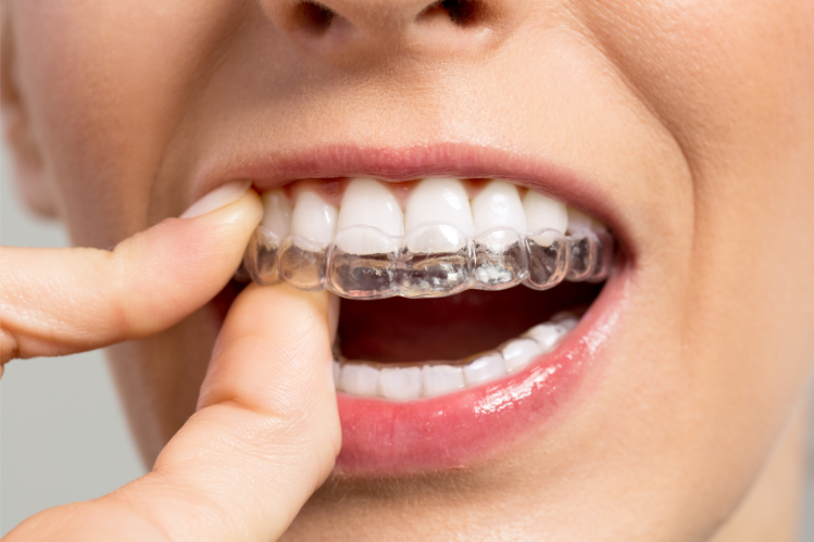 A woman applying invisible braces to her upper teeth.