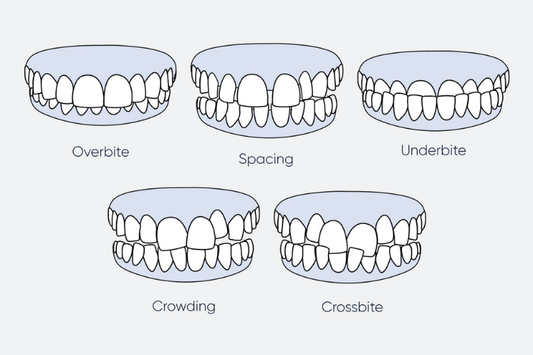 An illustration of different types of malocclusions (misaligned bite)