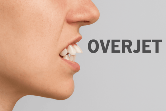 A woman with severe overjet teeth