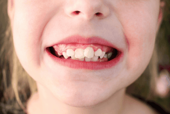 How Orthodontics Corrects Overlapping Teeth | A Complete Guide – Aligner32