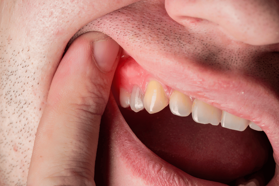 The Impact of Diabetes on Your Teeth and Gums