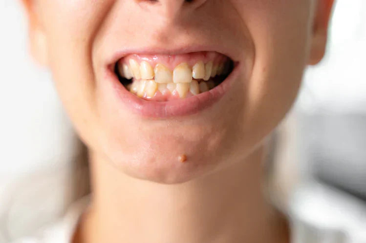 Close view of a woman’s slanted teeth