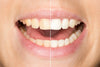 The Science Behind Teeth Whitening: How Do Those Kits Work?