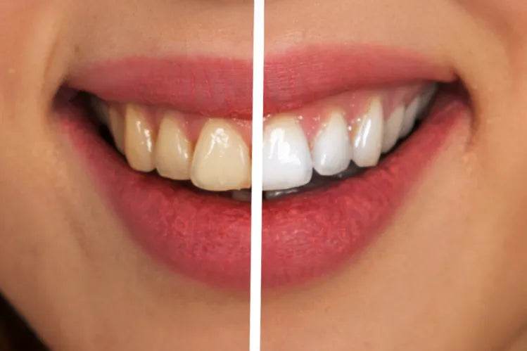 Teeth whitening before and after 