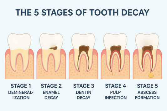 The five stages of tooth decay 
