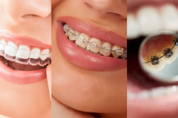 An image of a side by side comparison of clear aligners, ceramic braces, and lingual braces.