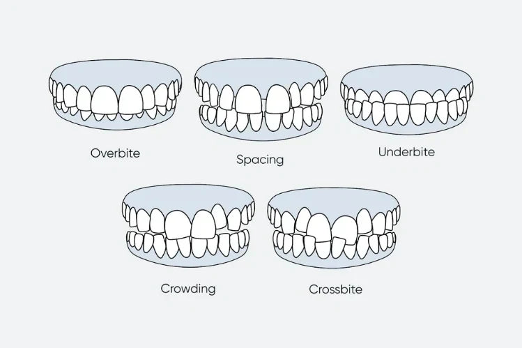 An illustration of different types of misaligned teeth 