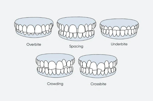 An illustration of different types of misaligned teeth 