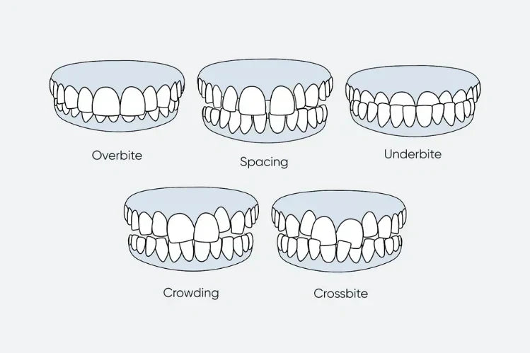 Illustration of all types of Misaligned teeth