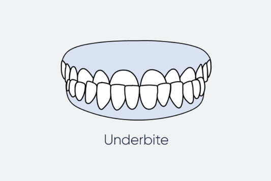 An illustration of an underbite