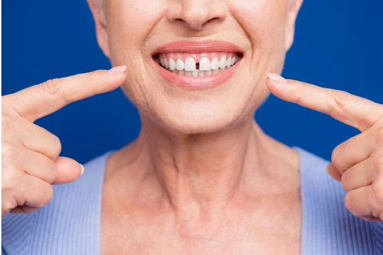 Older woman pointing to a gap between her front teeth