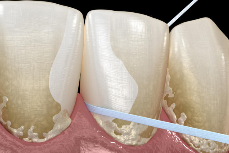 Flossing to remove plaque from teeth