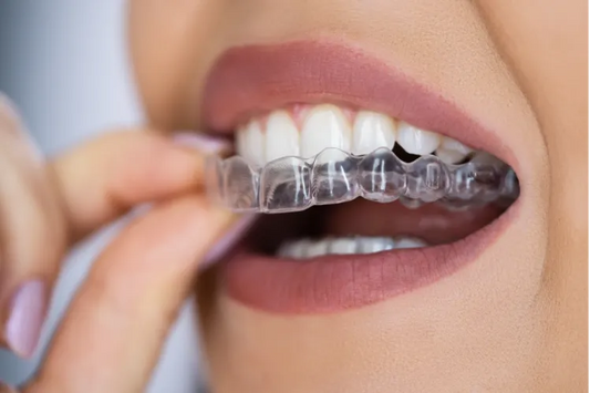 Complete Guide to Clear Aligners for Teeth Straightening