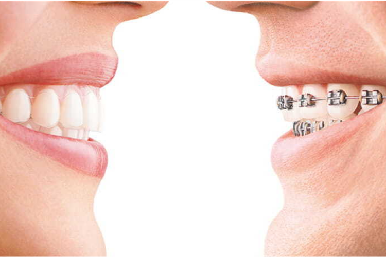 An image showing teeth straightening options: Aligners and Braces.